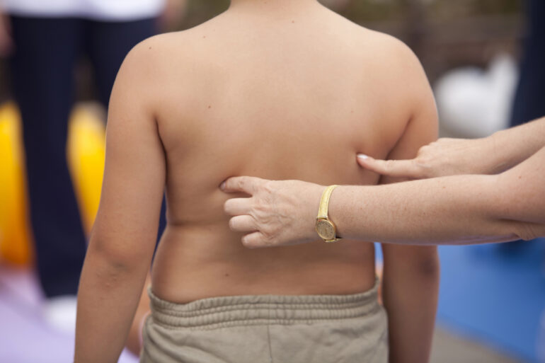 obesità infantile Italia